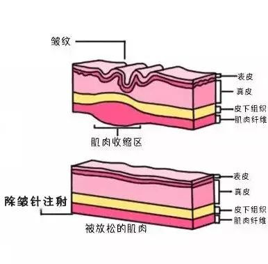 抬头纹好不好