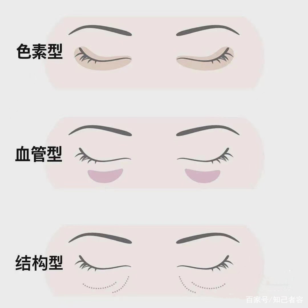 黑眼圈是睡眠不足造成的吗？