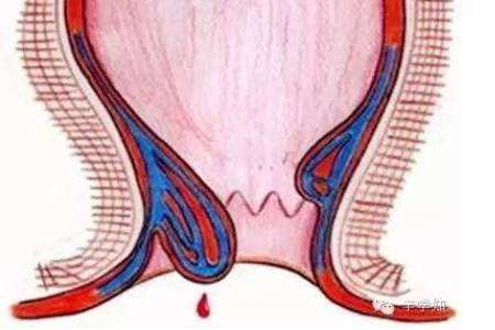 痔疮是什么样子？