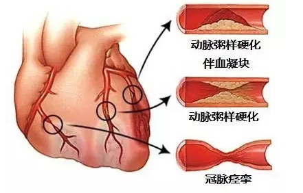 冠心病能治好吗