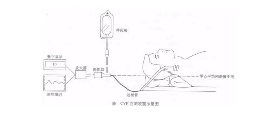 中心静脉压名词解释