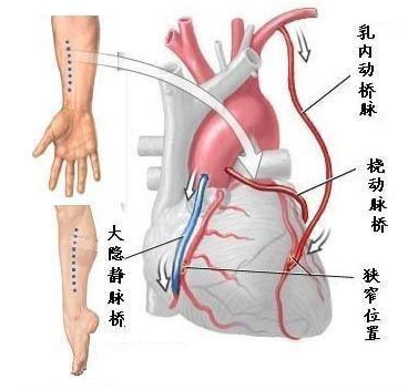 冠心病能治好吗