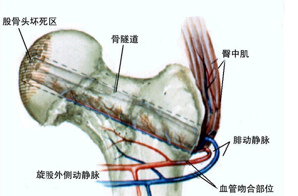 股骨头坏死是什么原因导致的啊？