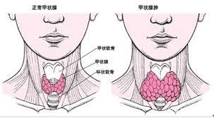 甲状腺肿大最常见的原因是什么？