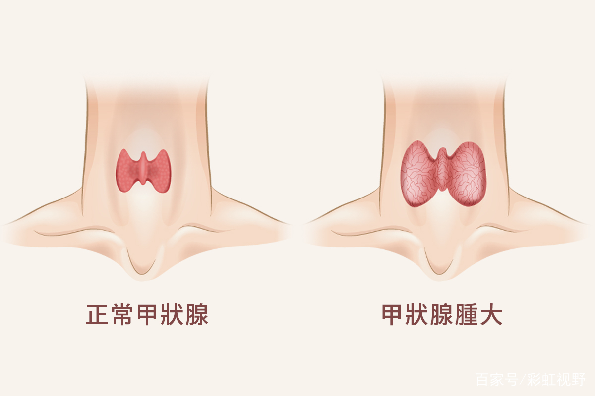 甲状腺肿大最常见的原因是什么？