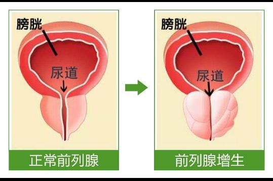 前列腺增生会尿急尿不尽吃什么药才好