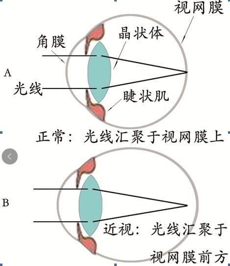 眼睛近视怎么办才能恢复