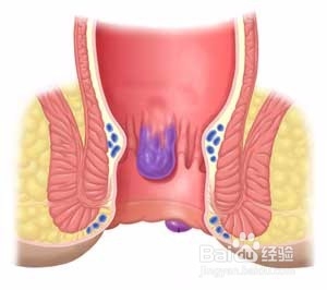 怎样用无花果巧治痔疮？