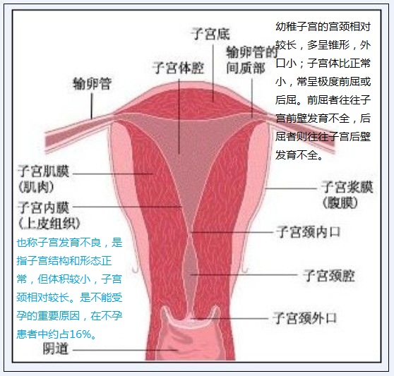 幼稚子宫