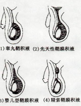 鞘膜积液手术的手术步骤